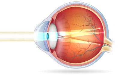 diagram of an eye with astigmatism