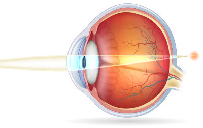 diagram of an eye with hyperopia